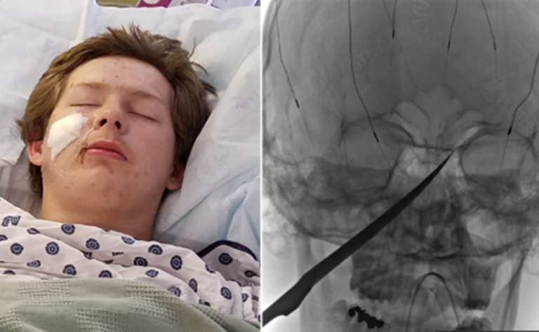 Teen Survives After 10 Inch Knife Lodged In His Face Narrowly Missing His Brain